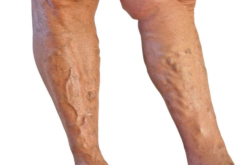 Illustration for article titled Obesity and the Development of Enlarged Veins